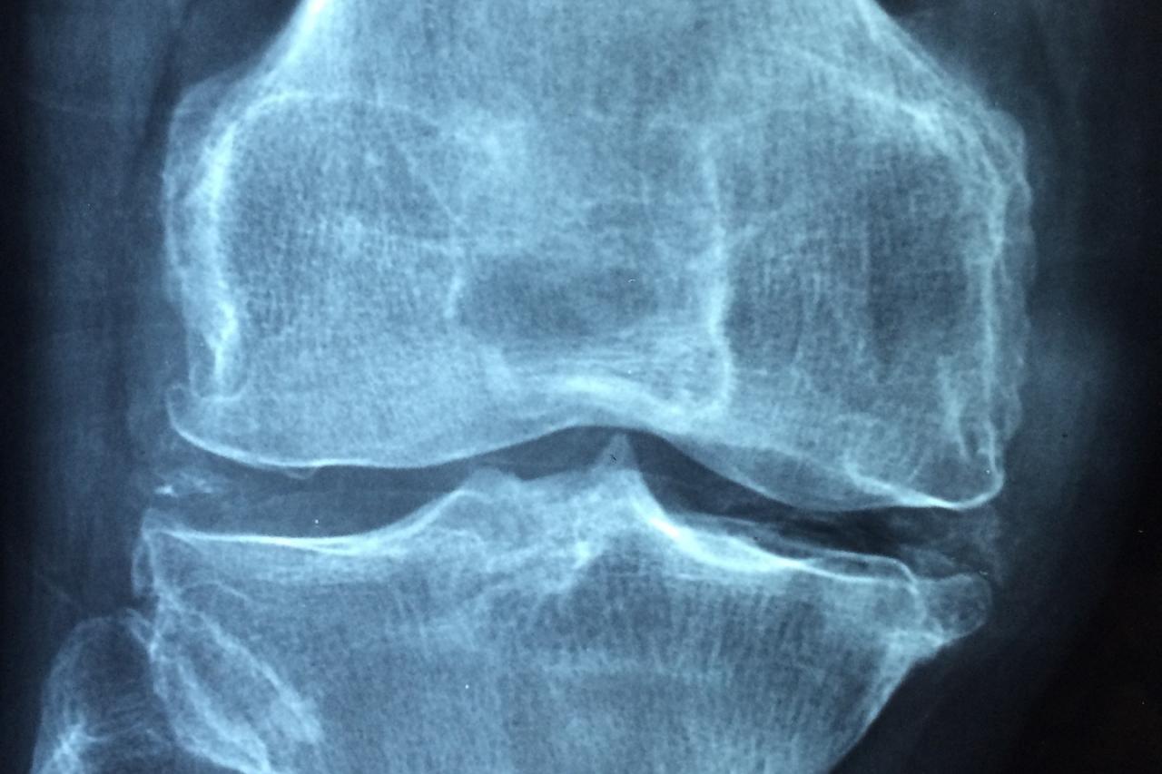 Bone Density / Osteoporosis Screening