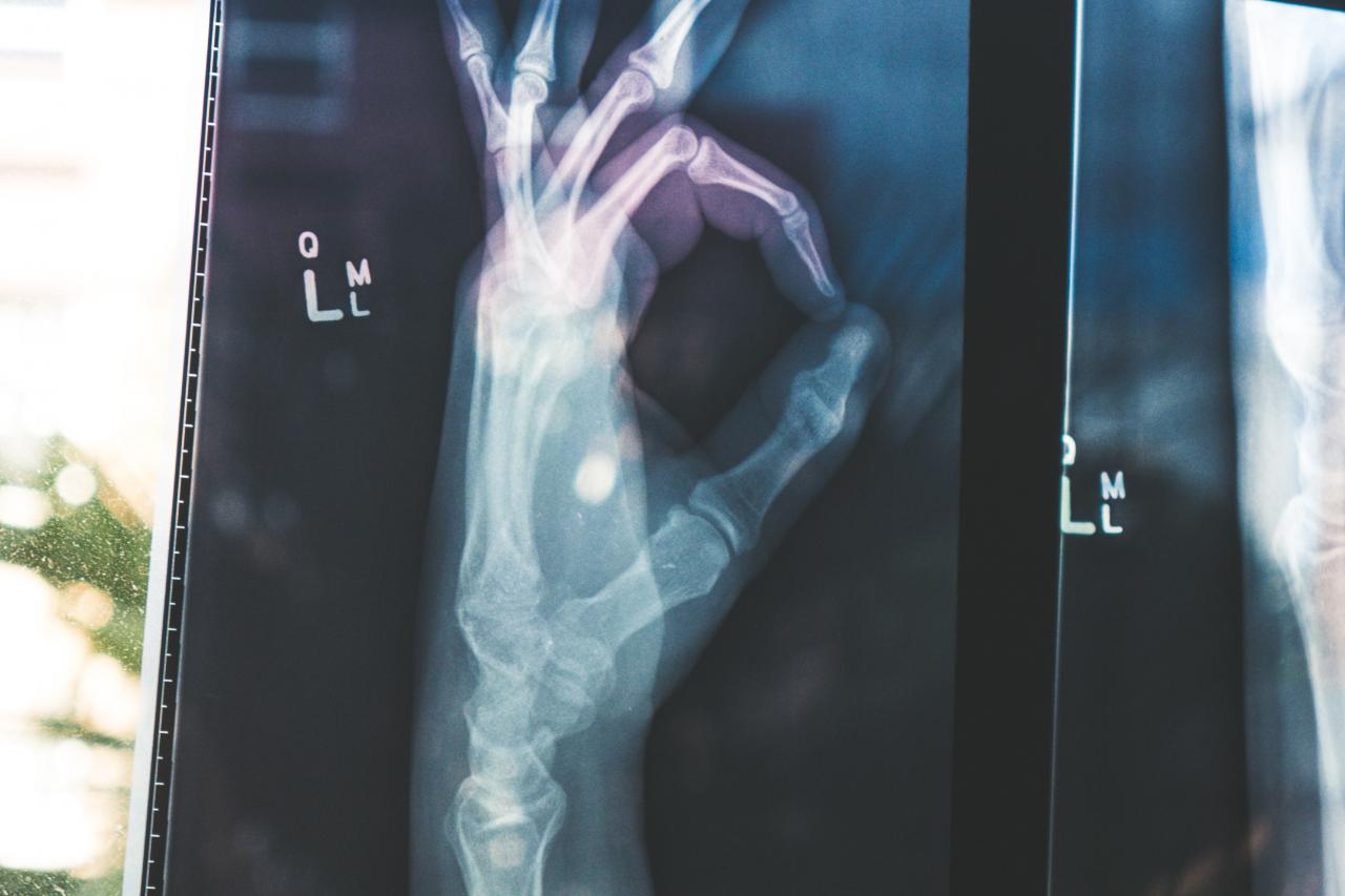 x-ray of a hand