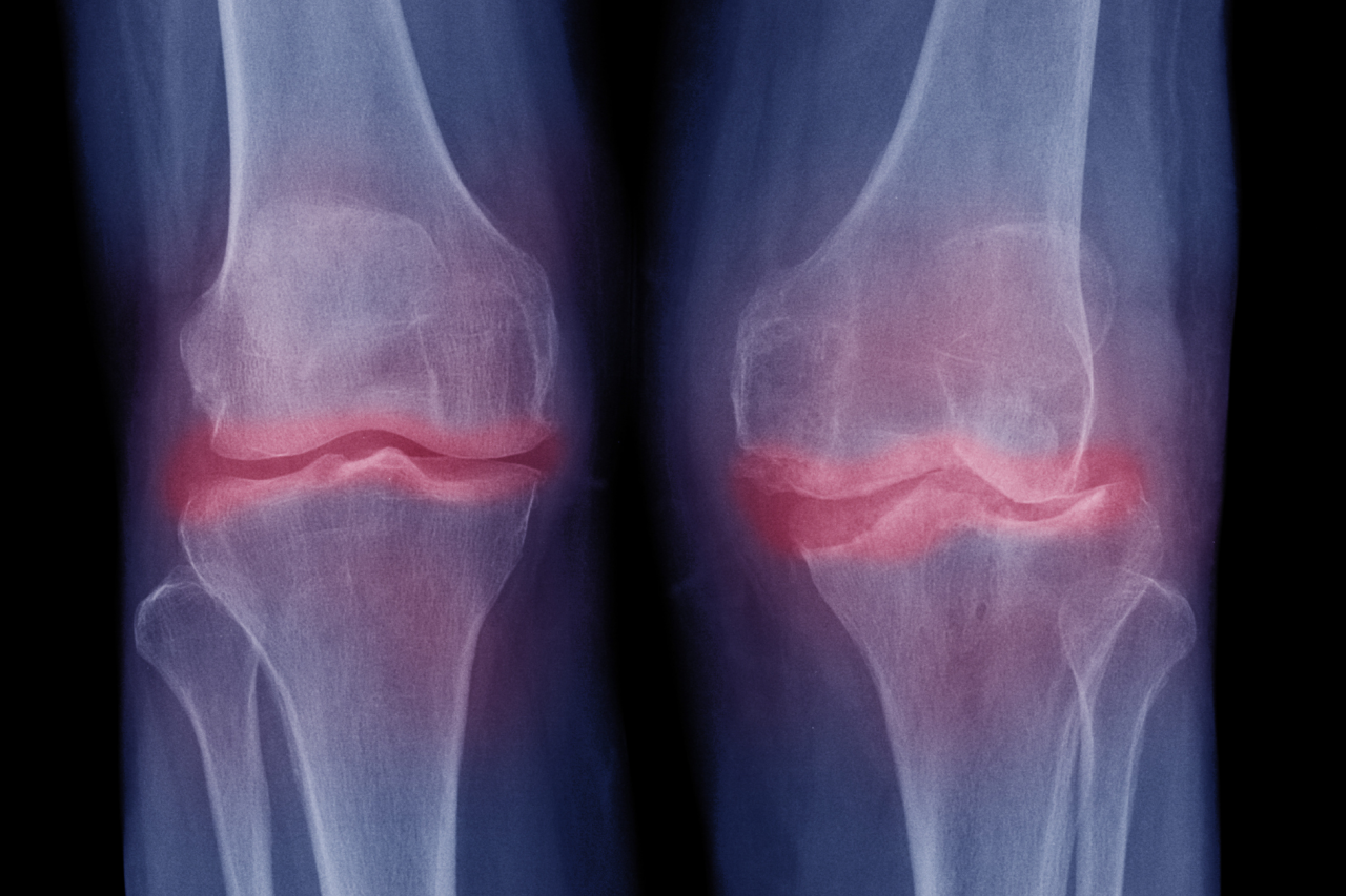 X-ray image of both knees with osteoarthritis