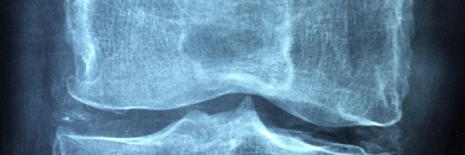 Detección de densidad ósea / osteoporosis