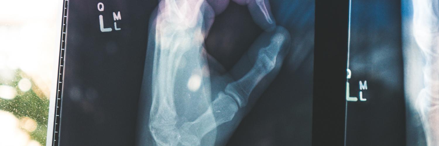 x-ray of a hand