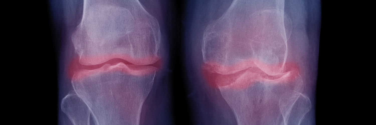 X-ray image of both knees with osteoarthritis